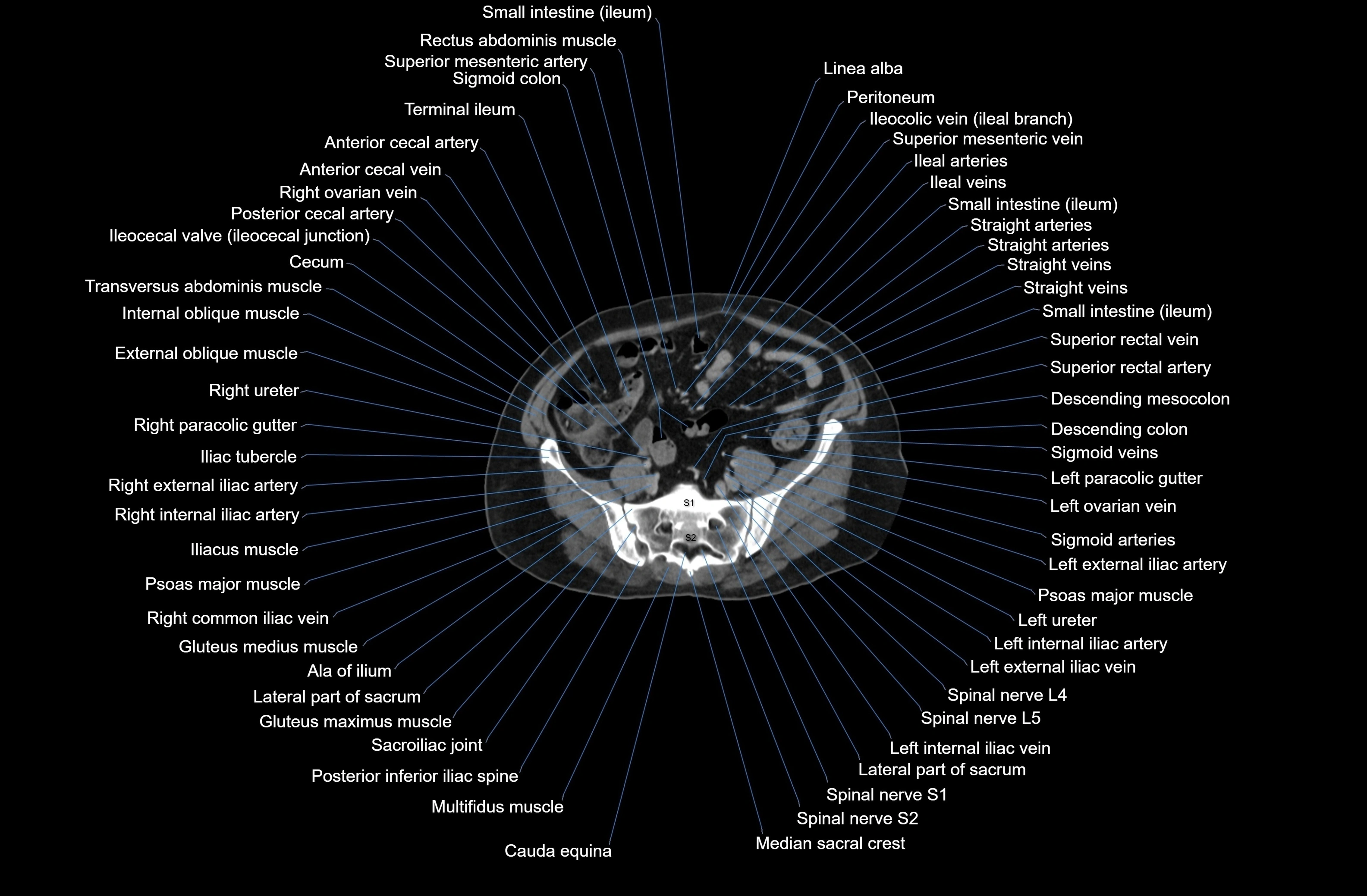 CT Abdomen axial cross sectional anatomy labelled radiology image-00068.webp